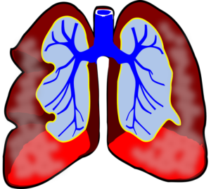 Při astmatu dochází k postižení průdušek.